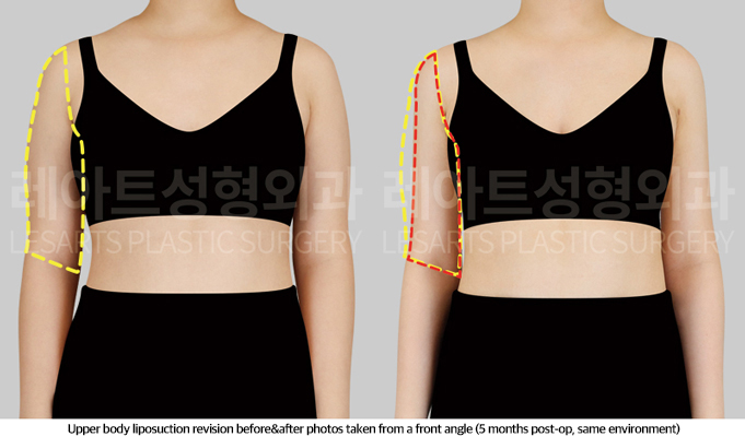 upper_body_liposuction_02_03_250513