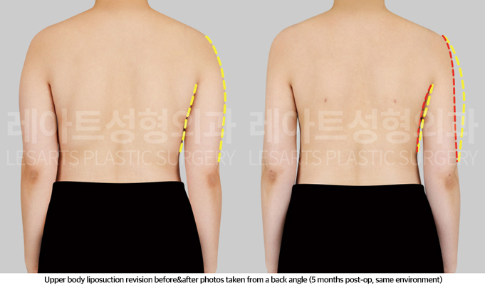 upper_body_liposuction_02_04_250513