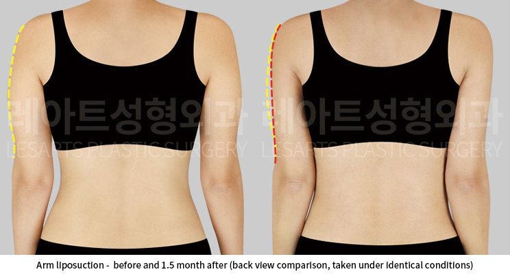 upper_body_liposuction_02_04_250528