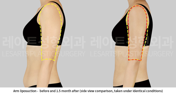 upper_body_liposuction_02_05_250528