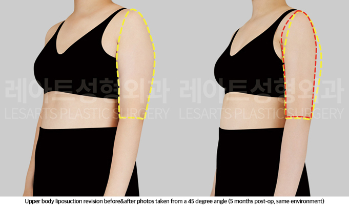 upper_body_liposuction_02_06_250513
