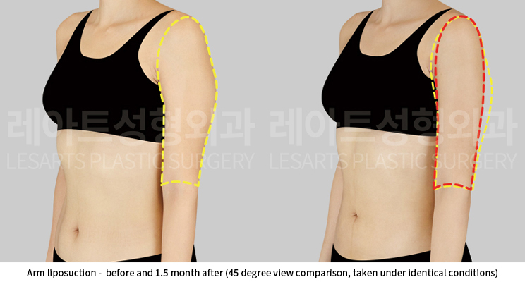 upper_body_liposuction_02_06_250528