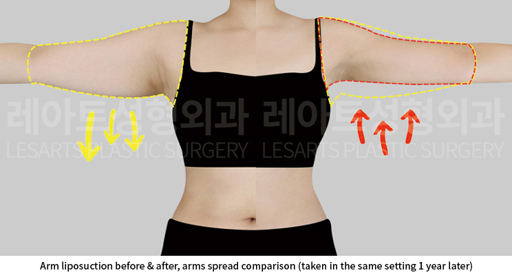 upper_body_liposuction_02_06_250613
