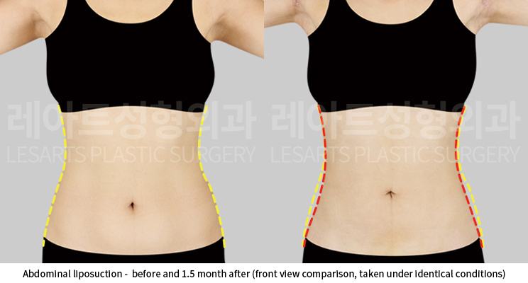 upper_body_liposuction_02_07_250528