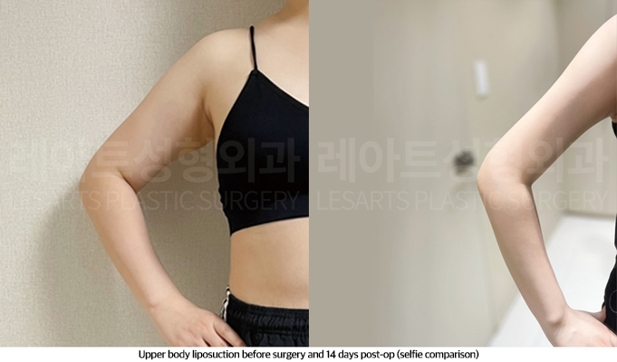 upper_body_liposuction_02_08_250513