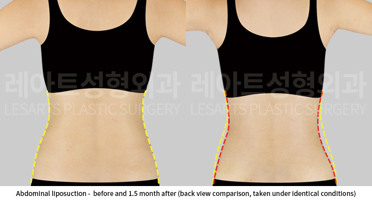 upper_body_liposuction_02_08_250528