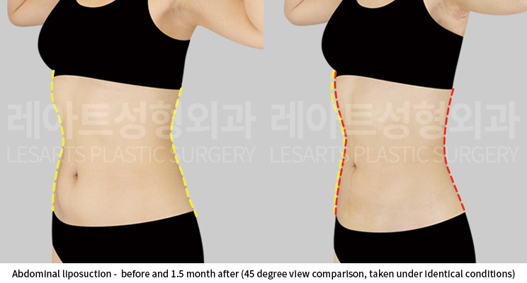 upper_body_liposuction_02_10_250528