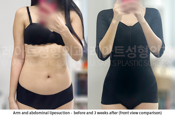 upper_body_liposuction_02_11_250528