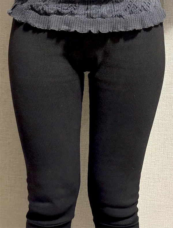 Gugugugde inner thigh liposuction before photo in Korea – Lesarts Plastic Surgery