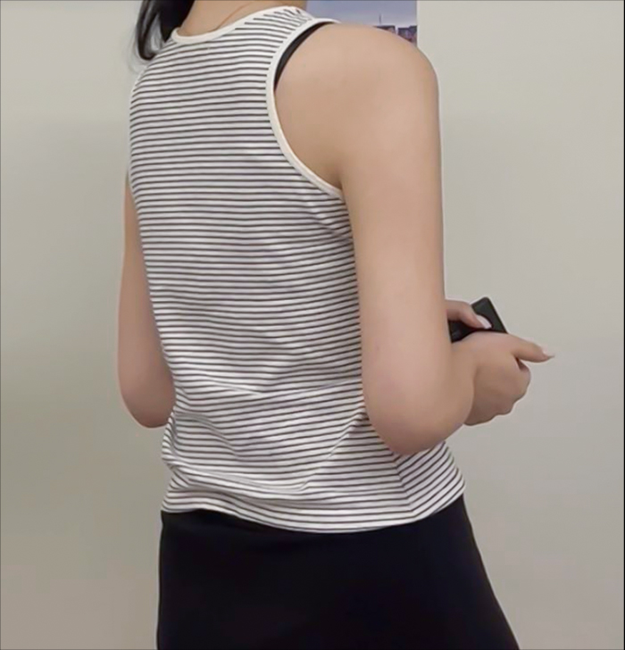 Arm liposuction 1 year after surgery in Korea – Lesarts Plastic Surgery