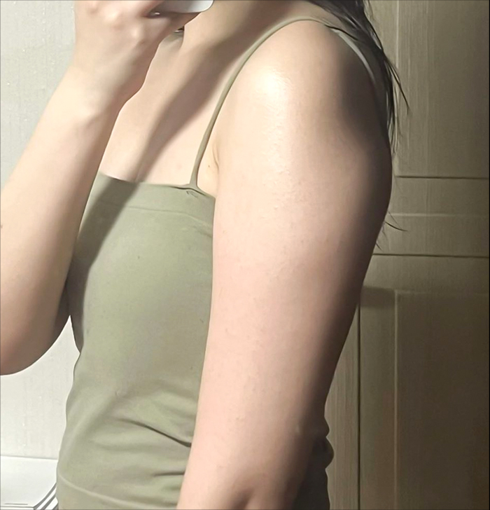 Arm liposuction before photo in Korea – Lesarts Plastic Surgery Gangnam