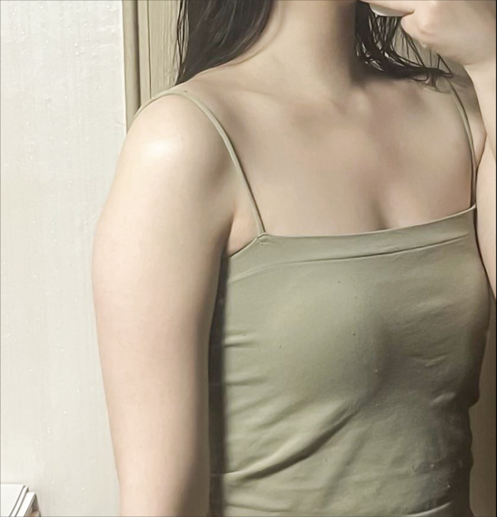 Arm liposuction before photo in Korea – Lesarts Plastic Surgery Gangnam
