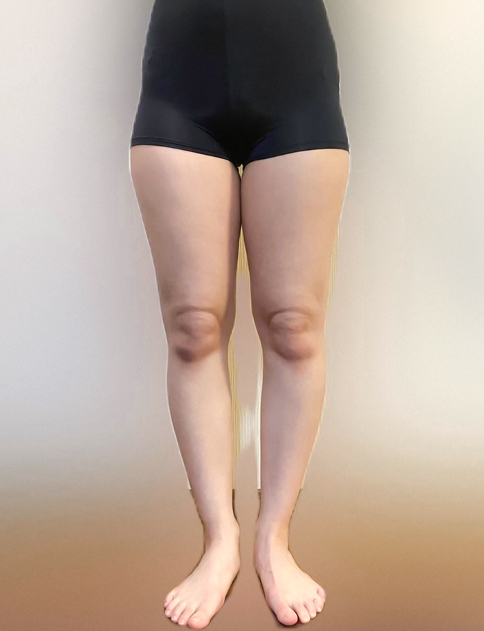 Uyupoku thigh liposuction before photo in Korea – Lesarts Plastic Surgery