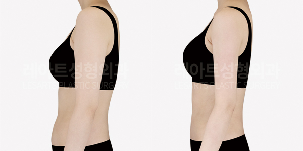 abdominal_liposuction_01_thumbnail_250708