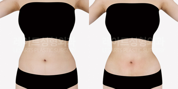 abdominal_liposuction_01_thumbnail_250718