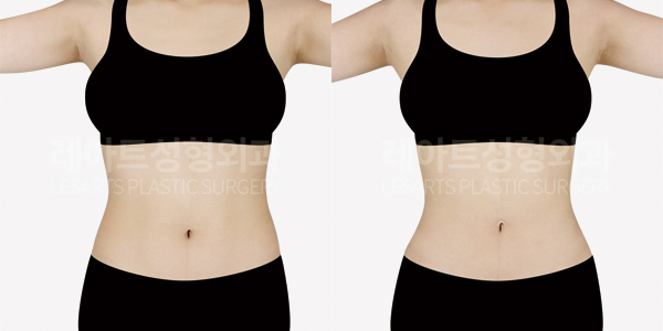 abdominal_liposuction_01_thumbnail_250801