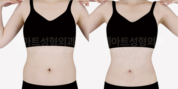 abdominal_liposuction_01_thumbnail_250805