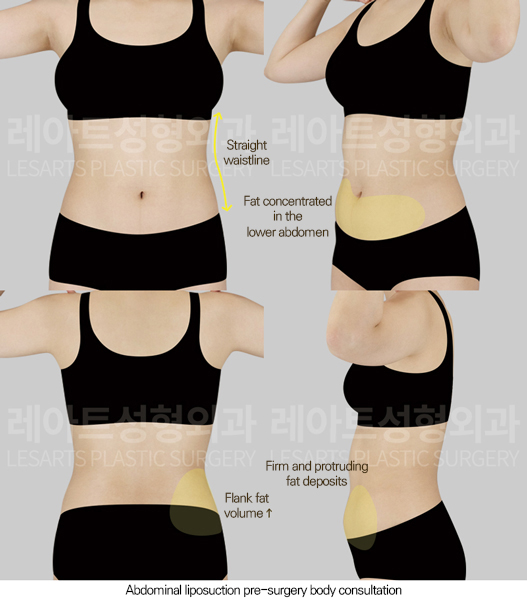 abdominal_liposuction_02_01_250801
