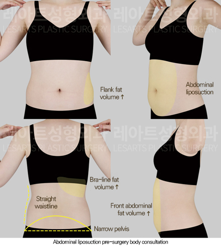abdominal_liposuction_02_01_250805