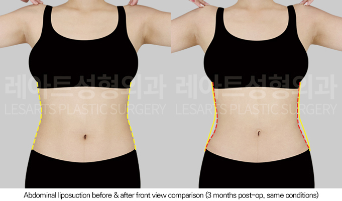 abdominal_liposuction_02_02_250801