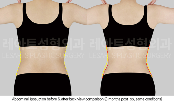 abdominal_liposuction_02_03_250801