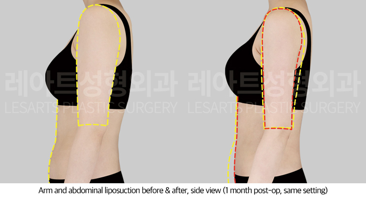 abdominal_liposuction_02_04_250708