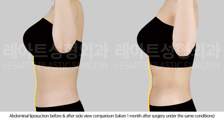 abdominal_liposuction_02_04_250718
