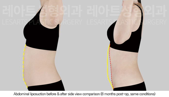 abdominal_liposuction_02_04_250805