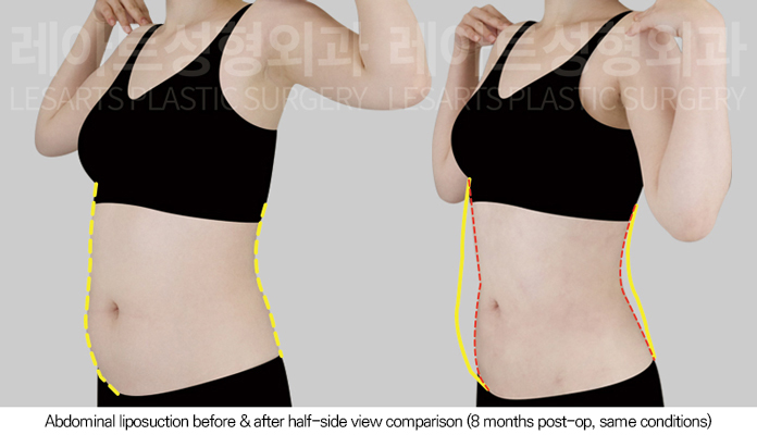 abdominal_liposuction_02_05_250805