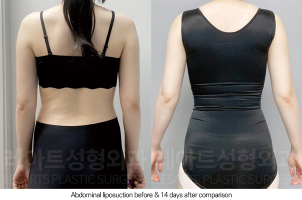 abdominal_liposuction_02_06_250805