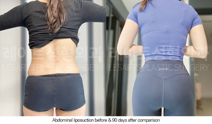 abdominal_liposuction_02_07_250801
