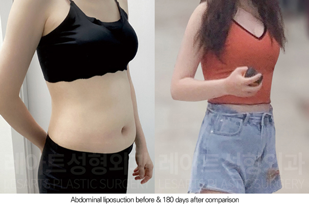abdominal_liposuction_02_08_250805
