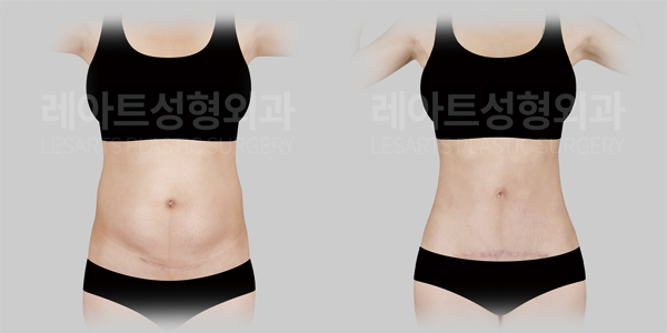 abdominoplasty_01_thumbnail_250722