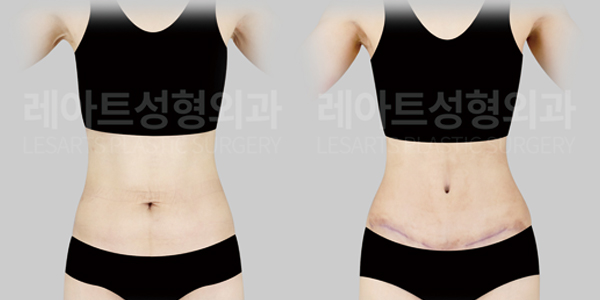 abdominoplasty_01_thumbnail_250724