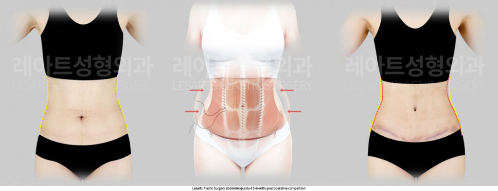 abdominoplasty_02_03_250724