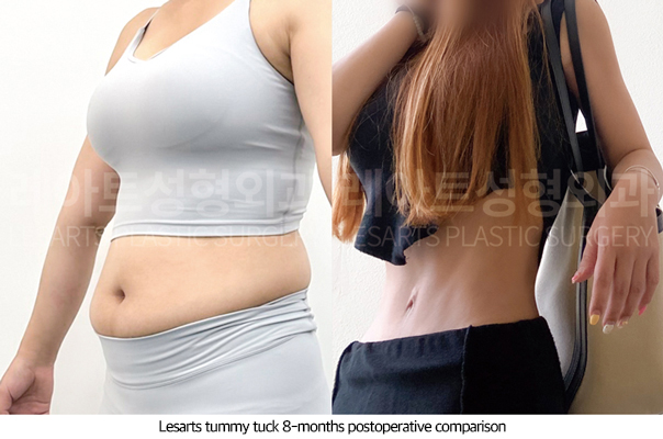abdominoplasty_02_04_250722