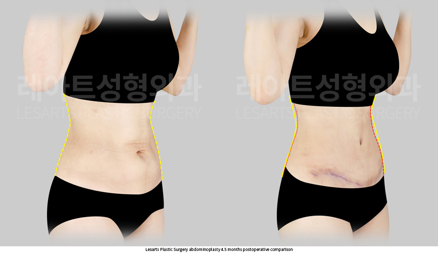 abdominoplasty_02_04_250724