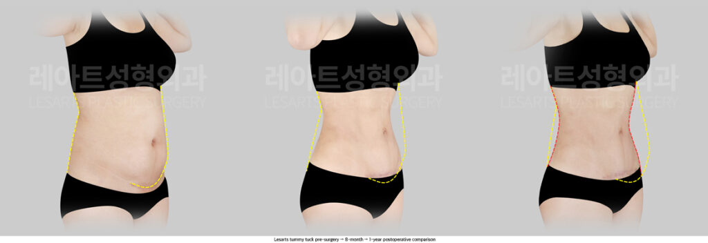 abdominoplasty_02_05_250722