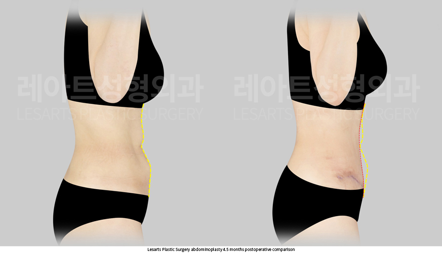abdominoplasty_02_06_250724
