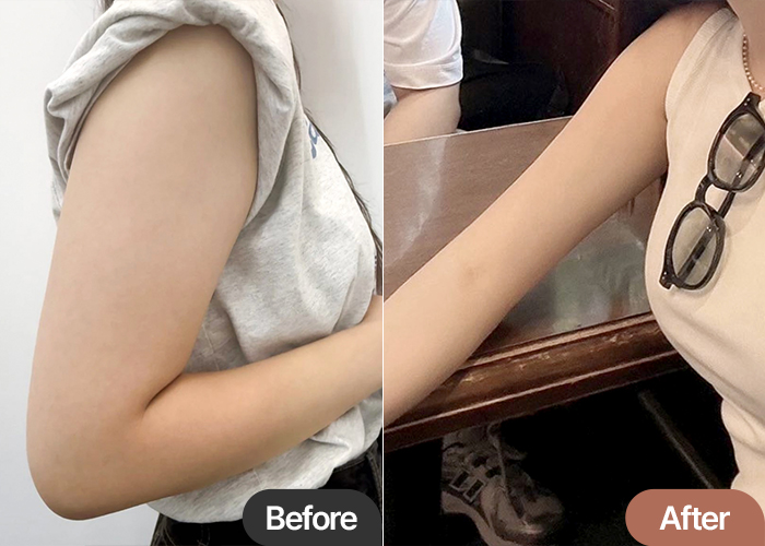 Cheokjjejjje arm liposuction before & after results in Korea – Best Plastic Surgery Clinic in Gangnam Lesarts