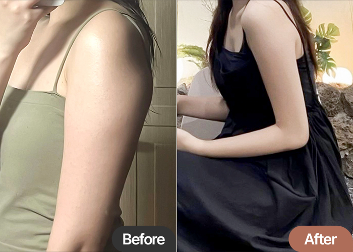 Arm liposuction before & after transformation in Korea – Best Plastic Surgery Clinic in Gangnam Lesarts