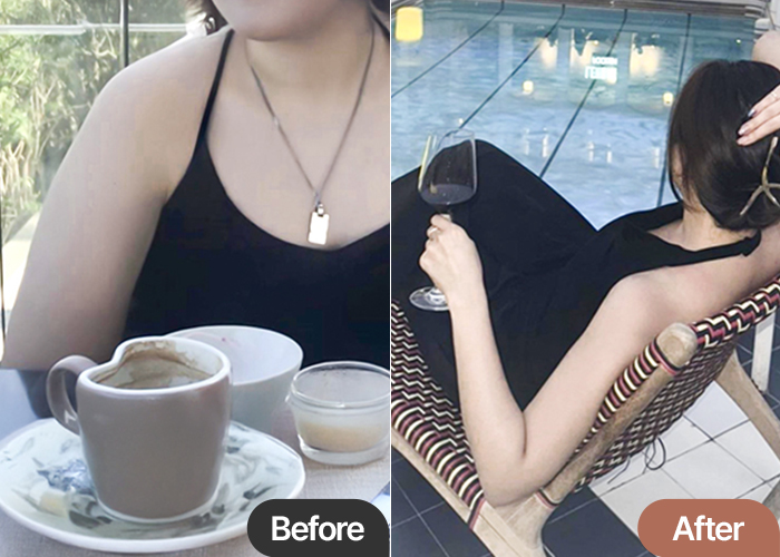 Rikka arm liposuction before and after comparison – Best Liposuction Clinic in Korea Lesarts