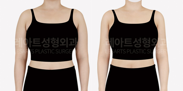 arm_liposuction_01_thumbnail_250711