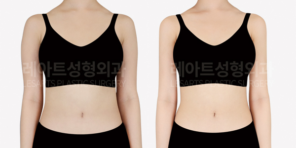 arm_liposuction_01_thumbnail_250715
