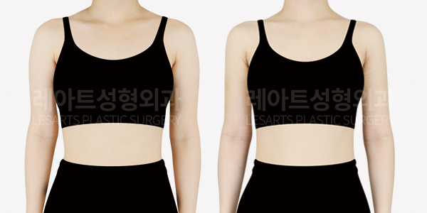 arm_liposuction_01_thumbnail_250722