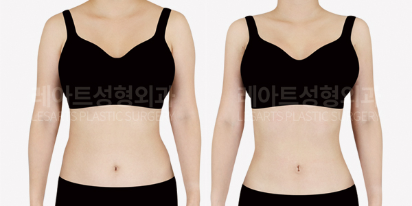 arm_liposuction_01_thumbnail_250808