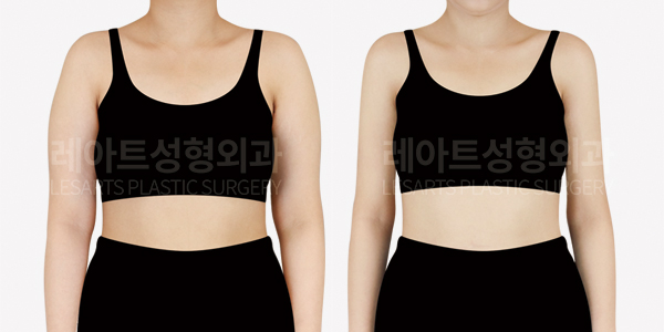 arm_liposuction_01_thumbnail_250812