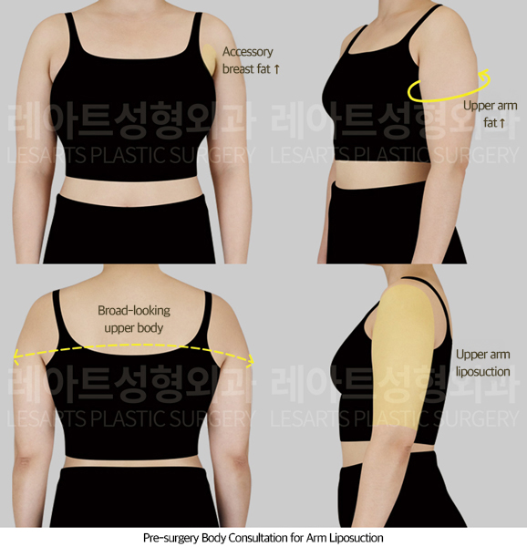 arm_liposuction_02_01_250711