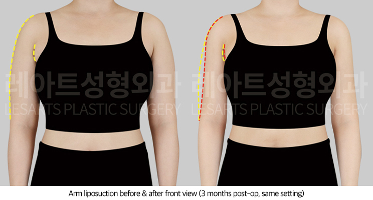 arm_liposuction_02_02_250711
