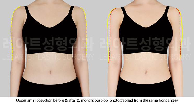 arm_liposuction_02_02_250715